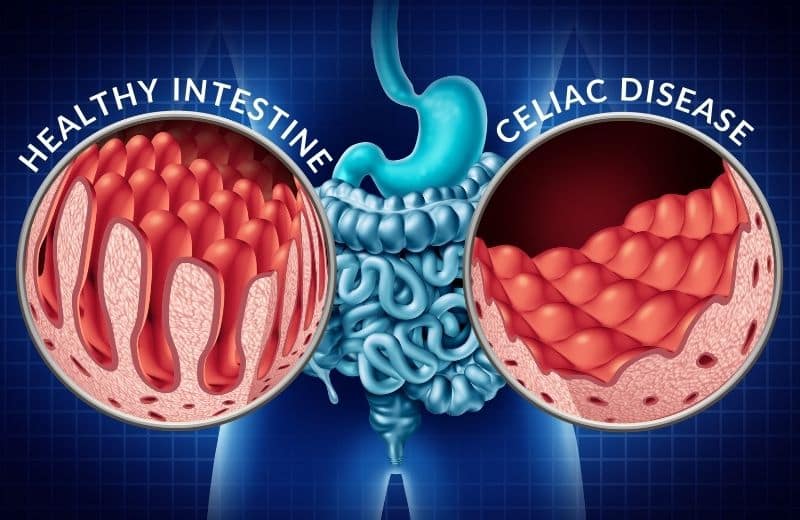 Animation of human body inflicted by celiac disease.