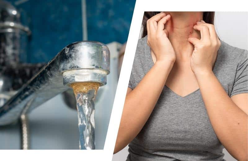 Hard water causes limescale deposits and dry and itchy skin